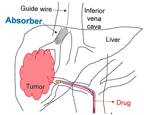 ayudas de esponja impresas en 3d en quimioterapia 5f6bdc8e38f91