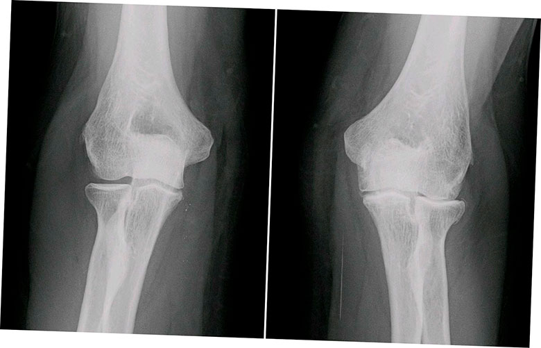 investigadores suecos imprimen con exito celulas madre en 3d para cartilago humano 5f6be997cf6d4